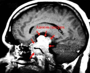 Расшифровка МРТ головного мозга с аденомой гипофиза