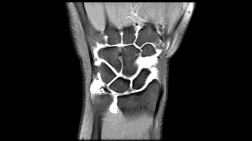 МРТ - Лучезапястный сустав