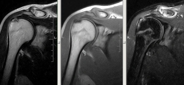 МРТ - Плечевой сустав