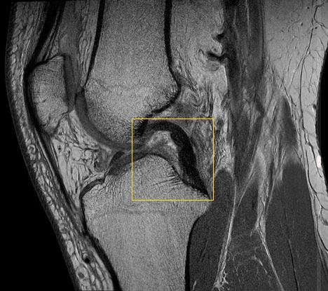 МРТ - Разрывы связок