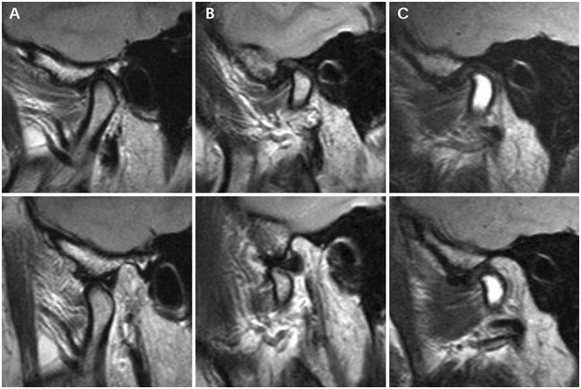 МРТ - Височно-нижнечелюстные суставы