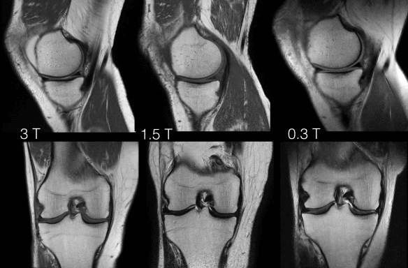 МРТ - Коленный сустав