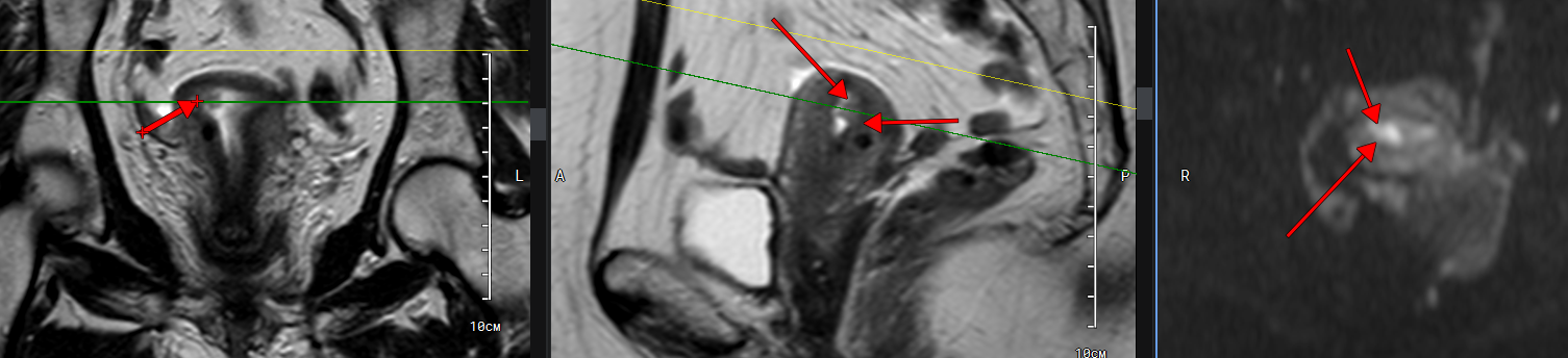 Пример МР-томограммы с раком матки