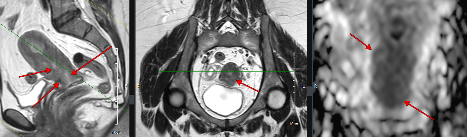 Пример снимка МРТ с раком шейки