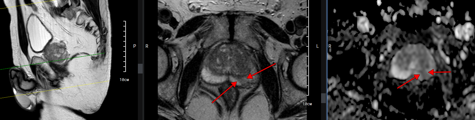 Пример снимка МРТ с неопластическим поражением периферической зоны левой доли предстательной железы без экстрапростатической экстензии