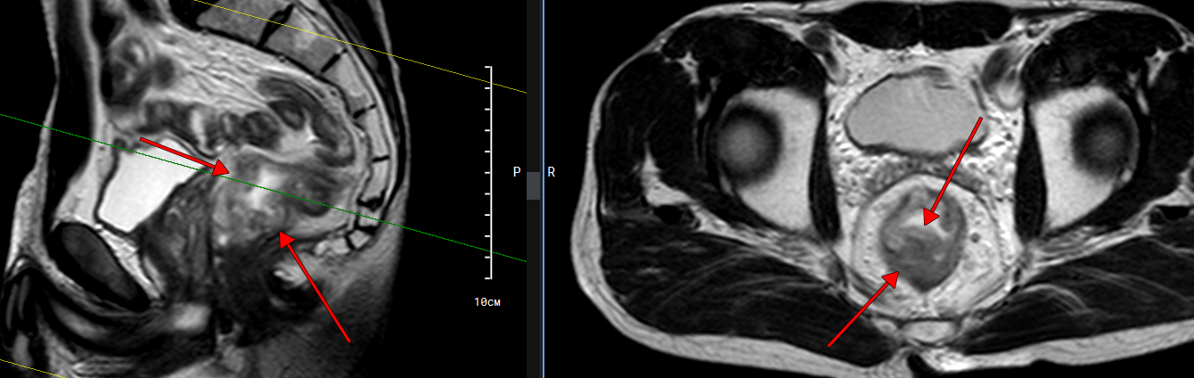 Пример МР-томограммы с неопластическим поражением нижнеампулярного отдела прямой кишки