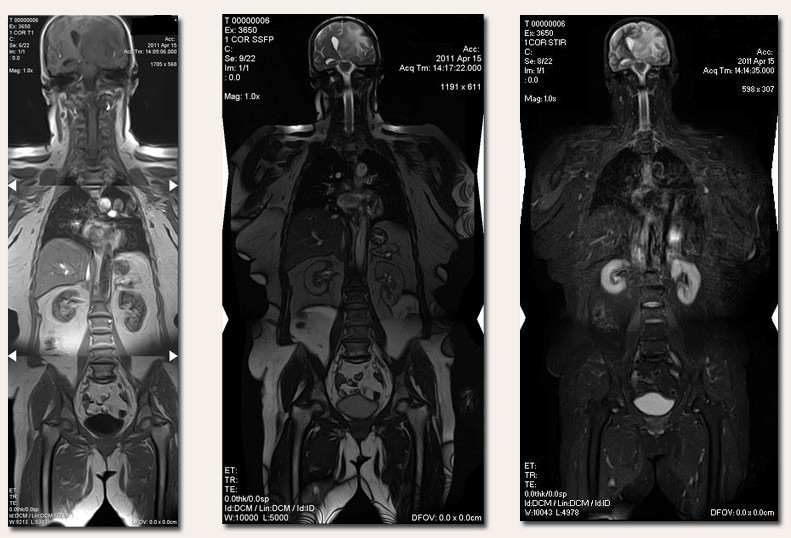 МРТ всего тела